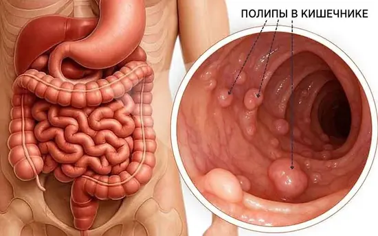 Всегда ли полипы толстой кишки нужно удалять?
