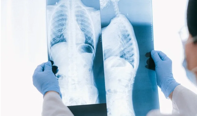 Лечение хронического бронхита