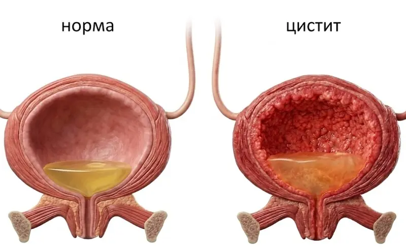 Что такое цистит